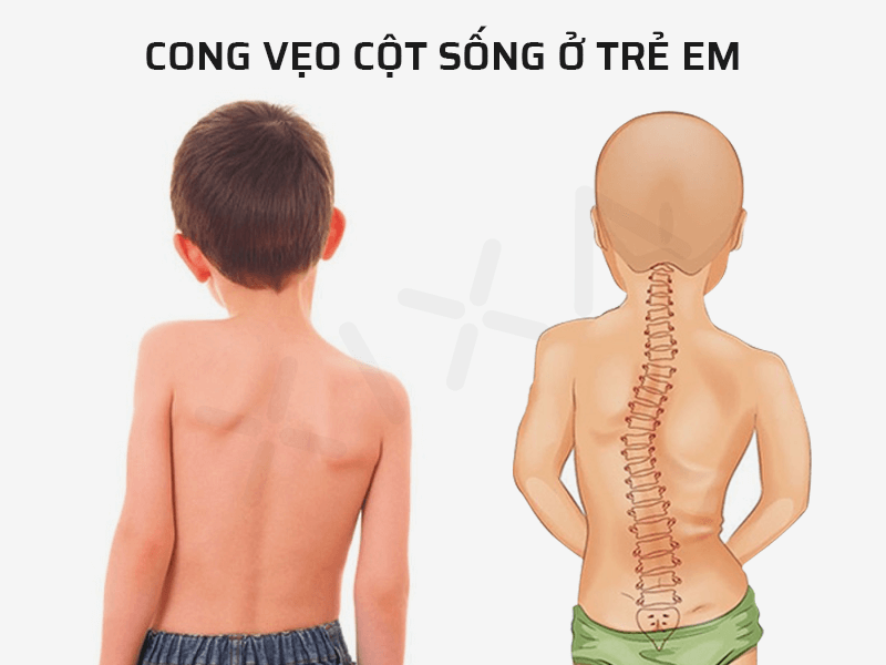 Vẹo cột sống ở trẻ nguyên nhân, biểu hiện và các biện pháp phòng ngừa