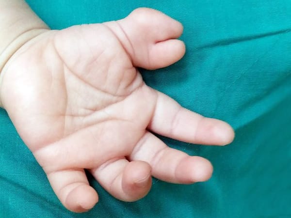 Tật thừa ngón tay, ngón chân ở trẻ khi nào cần phẫu thuật?