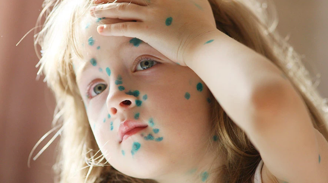 Chuyên gia nhi khuyến cáo cách chăm sóc trẻ khi bị thủy đậu