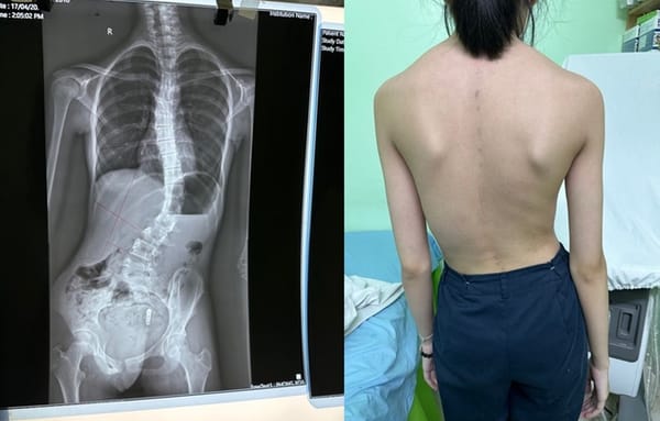 Cong vẹo cột sống ở trẻ: Những điều cha mẹ cần biết