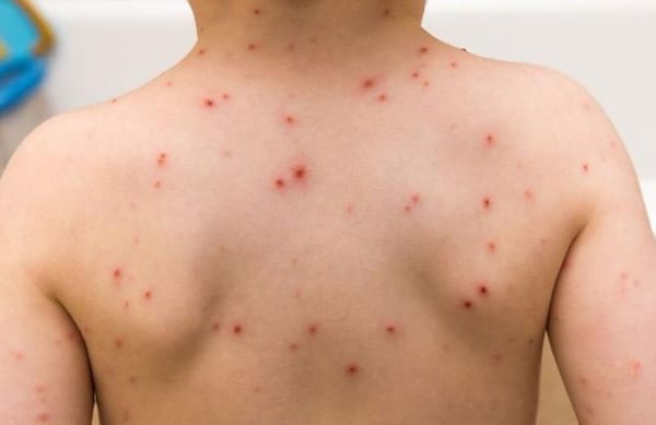 3 bệnh thường gặp ở trẻ vào mùa xuân