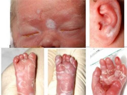 Bệnh giang mai bẩm sinh có chữa được không?