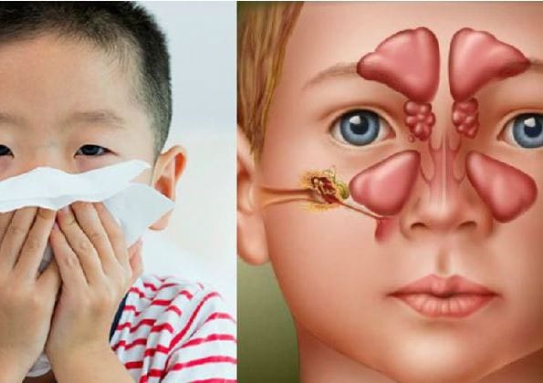 Biểu hiện thường gặp viêm mũi xoang ở trẻ
