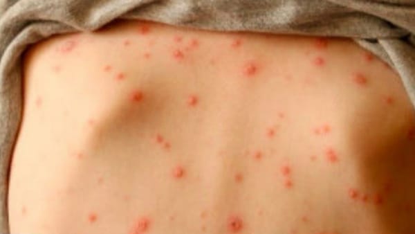 Chùm ca bệnh thủy đậu tại trường học ở Lào Cai, làm gì để phòng bệnh hiệu quả?