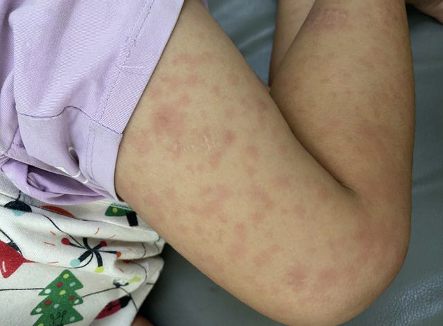 TPHCM xuất hiện nhiều ổ dịch sởi trong trường học