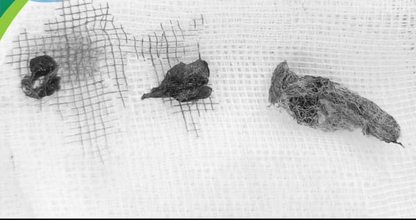 Bé gái 5 tuổi chảy máu âm đạo nhiều tháng vì lý do bất ngờ