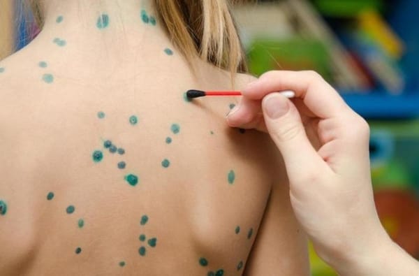 Cách chữa bệnh thủy đậu cho trẻ nhanh khỏi