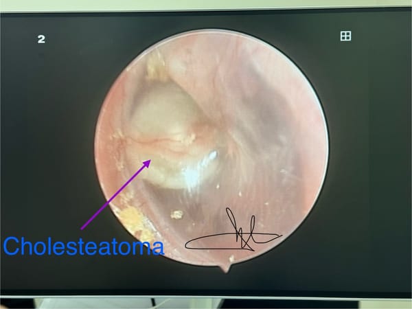 Bệnh Cholesteatoma bẩm sinh tai giữa và cách điều trị