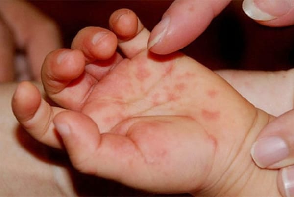 Bệnh tay chân miệng: khi nào chăm sóc trẻ tại nhà, khi nào cần đến viện gấp?