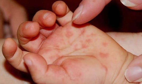 Giai đoạn khởi phát của bệnh tay chân miệng có biểu hiện gì?