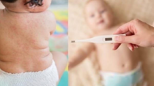 Cách phát hiện sớm sốt phát ban ở trẻ