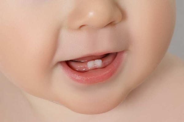 Trẻ chậm mọc răng: nguyên nhân và dấu hiệu cần lưu ý