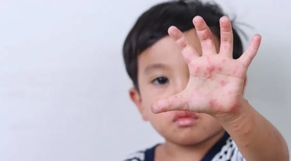 Vì sao bệnh tay chân miệng tăng mạnh ở trẻ mầm non vào đầu tuần?