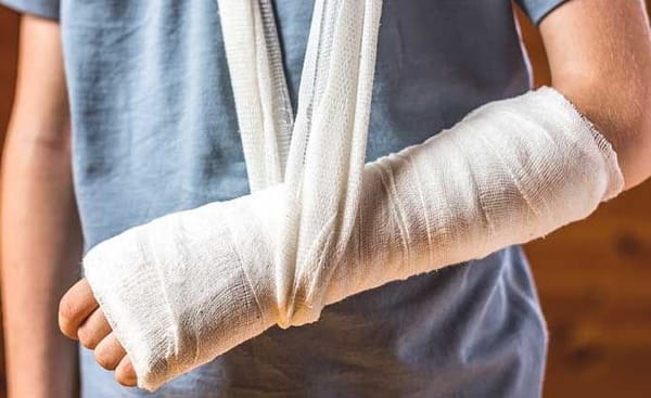 Gãy xương ở trẻ dịp hè: Đừng chủ quan sau chấn thương