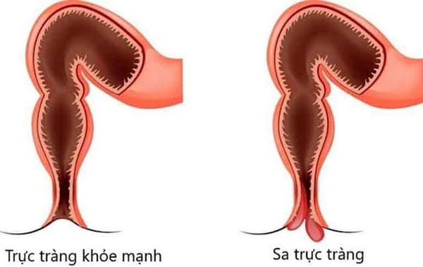 Sa trực tràng ở trẻ em có nguy hiểm?