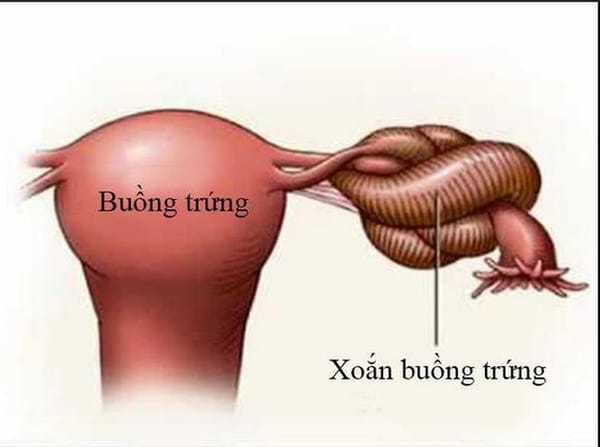 Đau bụng dữ dội, buồn nôn phát hiện xoắn u nang buồng trứng